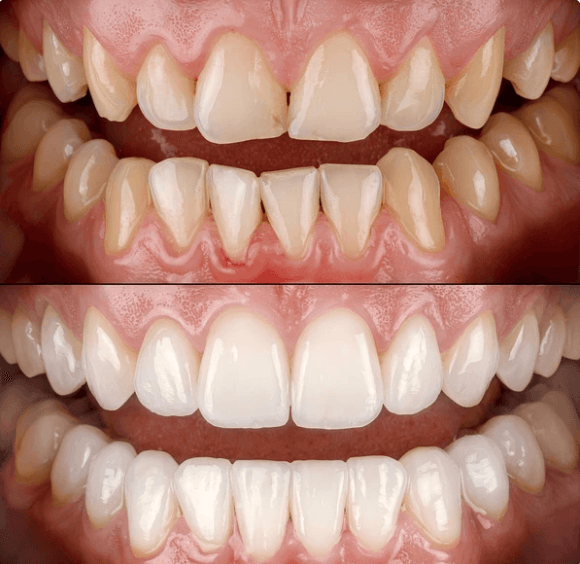 İmplant Tedavisi - Öncesi ve Sonrası - DentNora