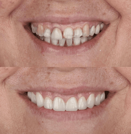 Lamina Kaplama - Öncesi ve Sonrası - DentNora