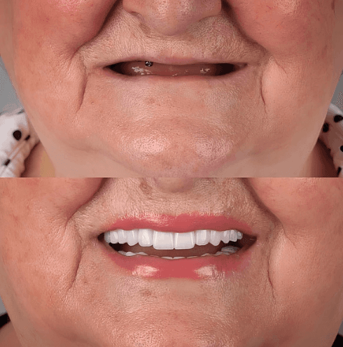 Diş Eti Tedavisi - Öncesi ve Sonrası - DentNora