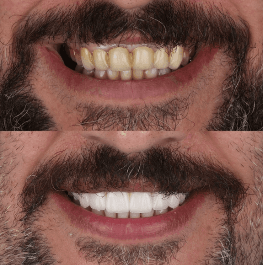 Hollywood Gülüşü - Öncesi ve Sonrası - DentNora