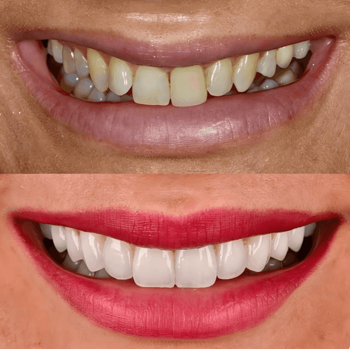 Gülüş Tasarımı - Öncesi ve Sonrası - DentNora
