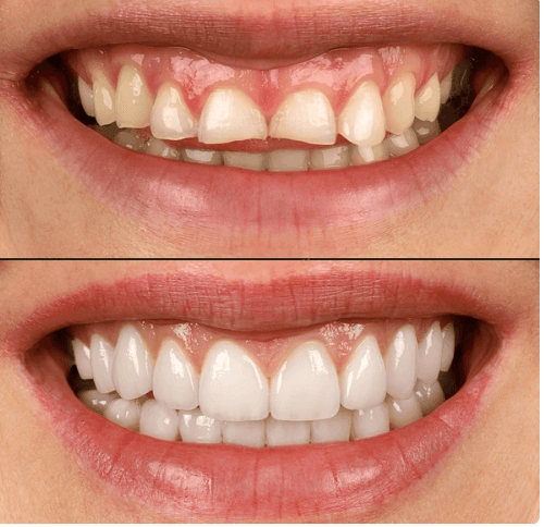 Diş Beyazlatma - Öncesi ve Sonrası - DentNora